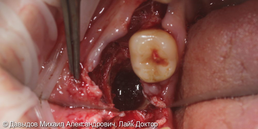 Удаление ретинированного зуба мудрости, удаление зуба 44 с одномоментной имплантацией, установка импланта 46 - фото №5
