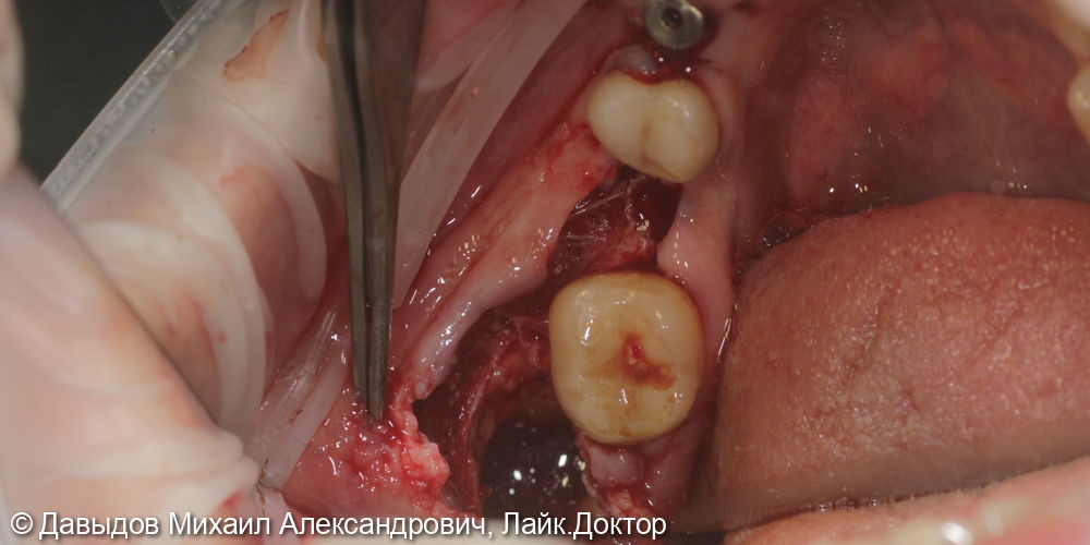 Удаление ретинированного зуба мудрости, удаление зуба 44 с одномоментной имплантацией, установка импланта 46 - фото №6