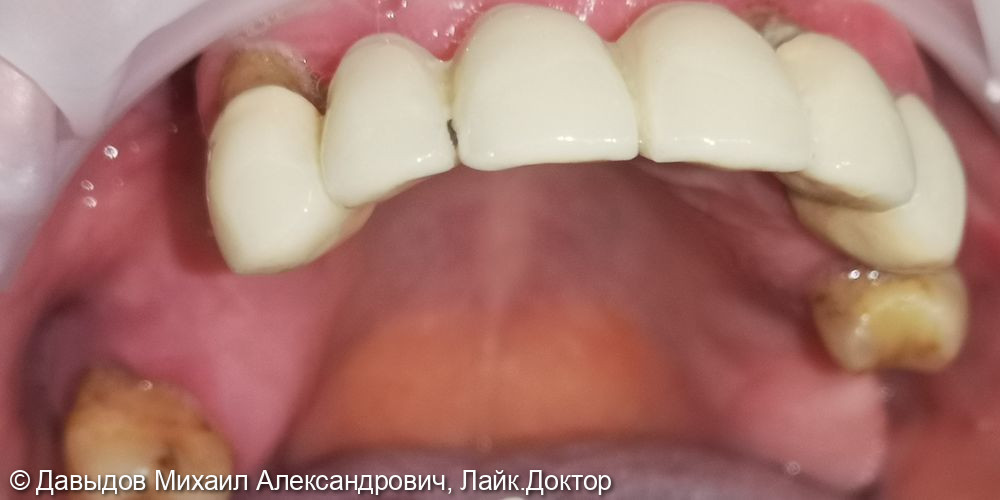 Зубы за один день - фото №3