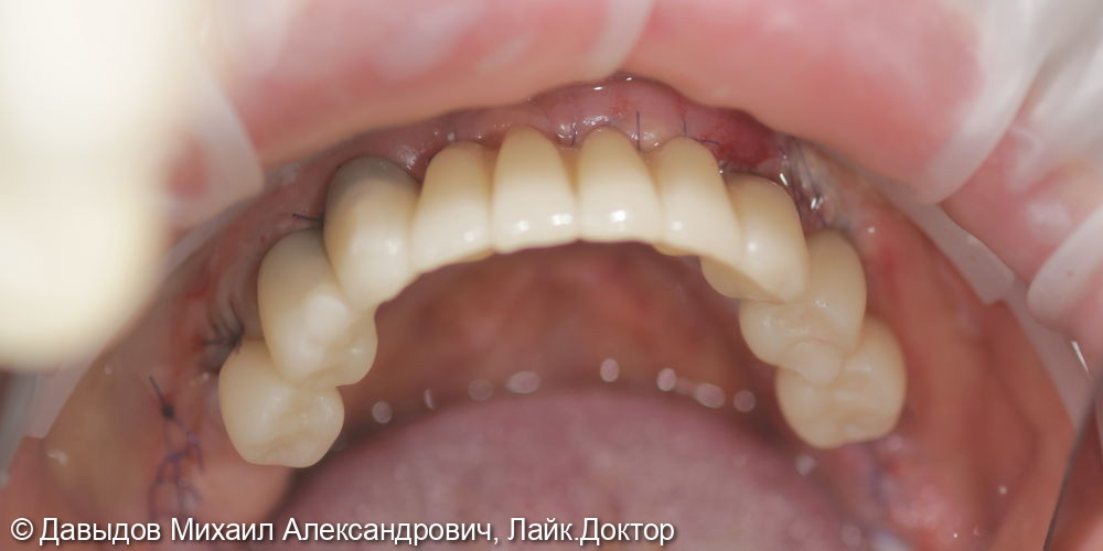 Зубы за один день - фото №12