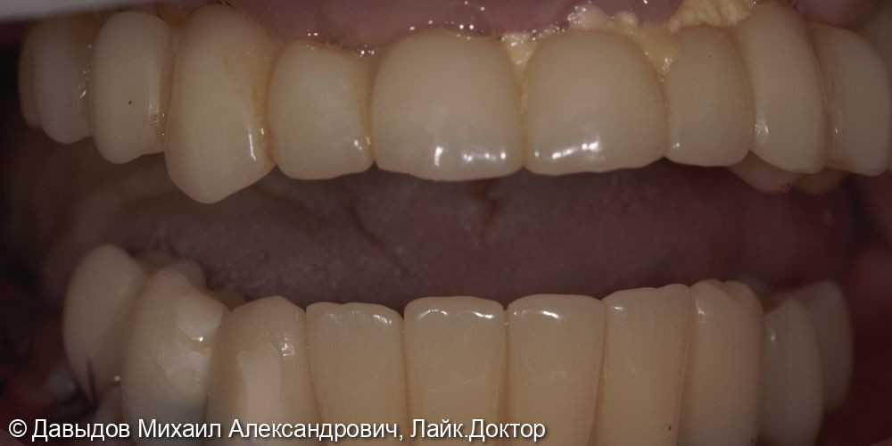 Зубы за один день - фото №13