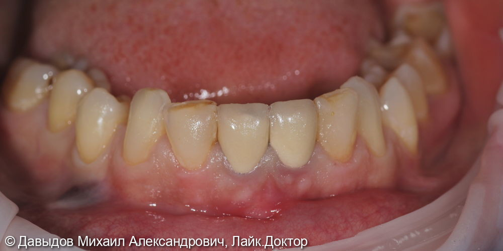 Удаление зуба 3.1 с одномоментной костной пластикой - фото №1