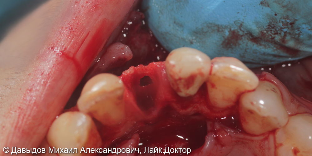 Удаление зуба 3.1 с одномоментной костной пластикой - фото №2