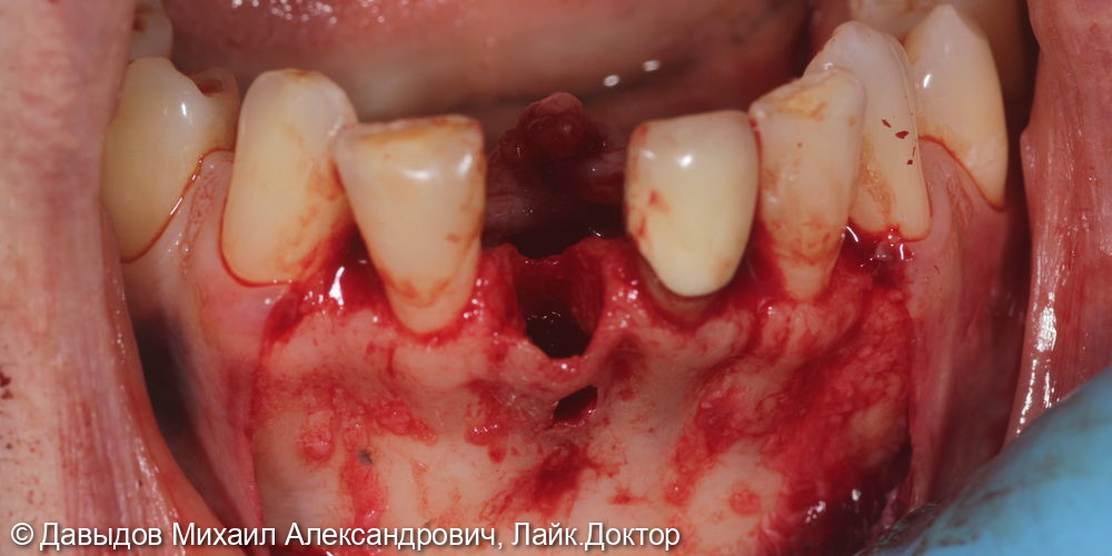 Удаление зуба 3.1 с одномоментной костной пластикой - фото №3