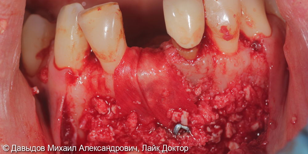 Удаление зуба 3.1 с одномоментной костной пластикой - фото №4