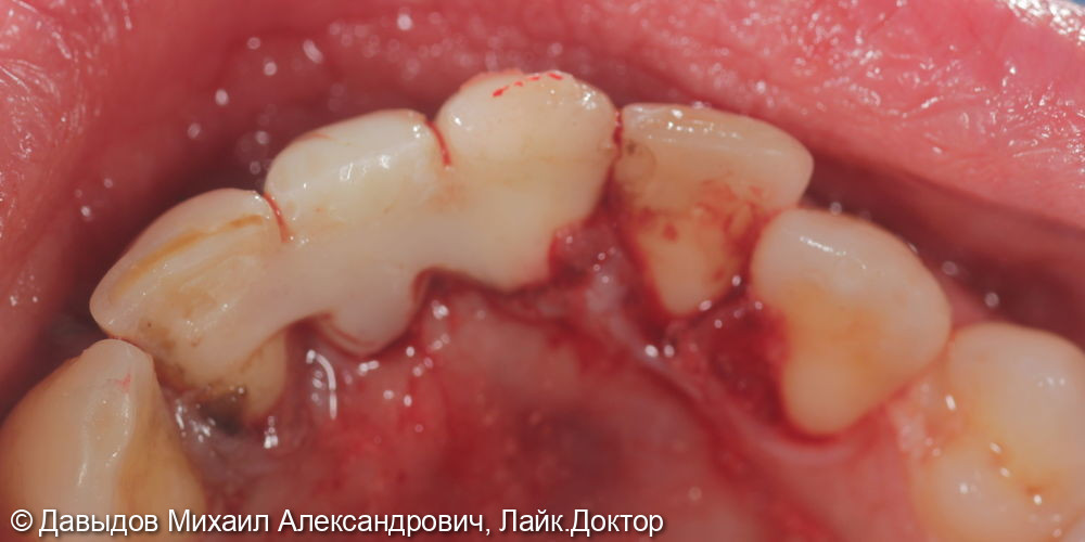 Удаление зуба 3.1 с одномоментной костной пластикой - фото №5