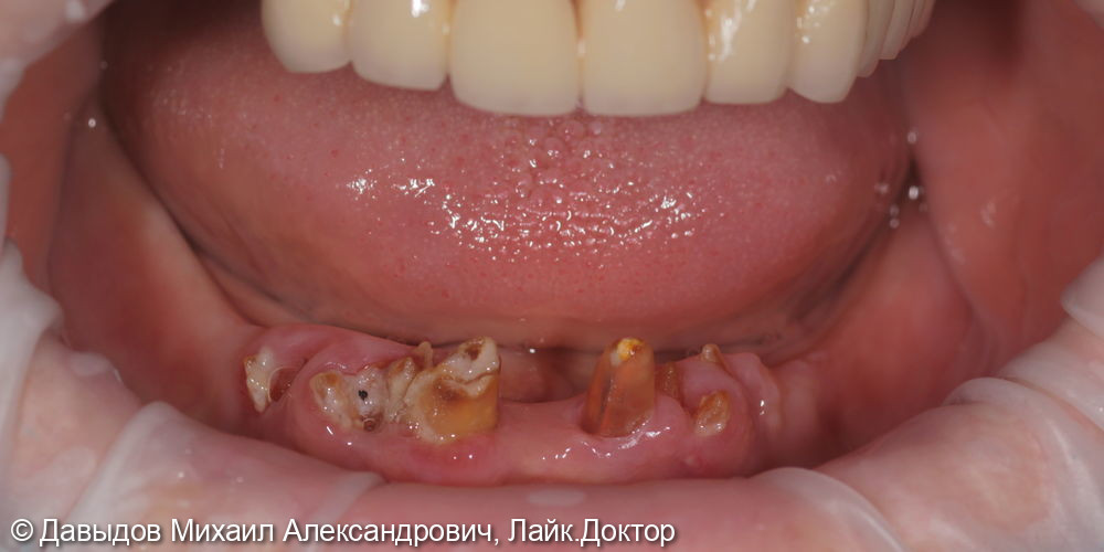 Зубы за один день: установка 4-х имплантов с немедленной нагрузкой - фото №1
