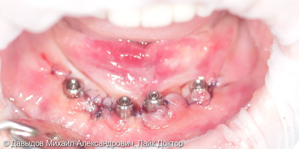 Зубы за один день: установка 4-х имплантов с немедленной нагрузкой - фото №5