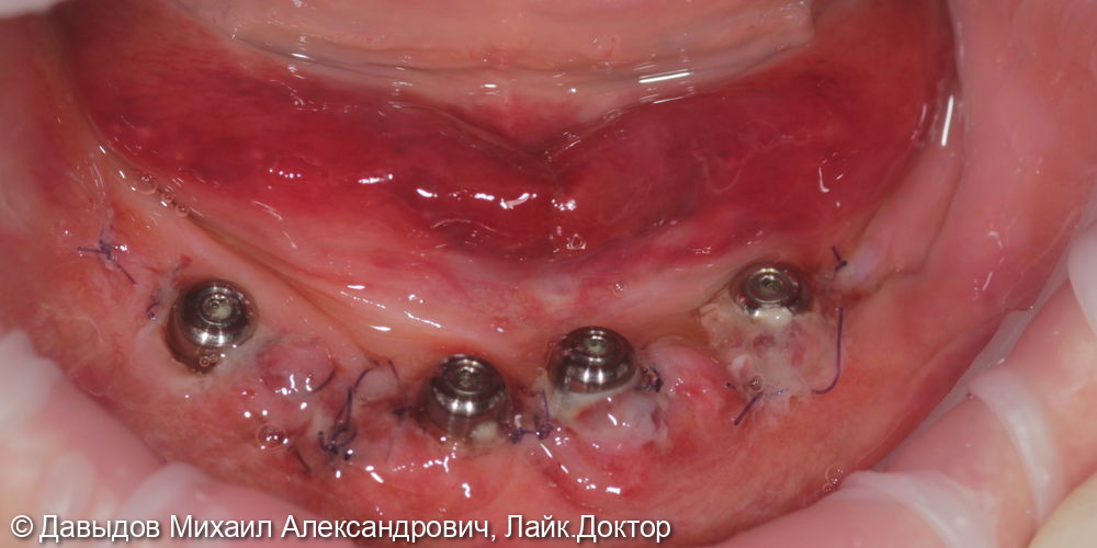 Зубы за один день: установка 4-х имплантов с немедленной нагрузкой - фото №6