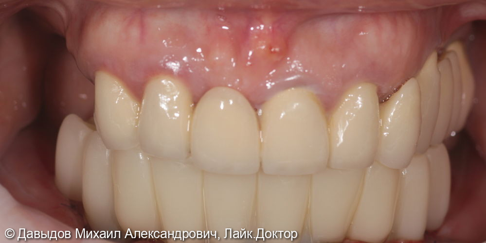 Зубы за один день: установка 4-х имплантов с немедленной нагрузкой - фото №8