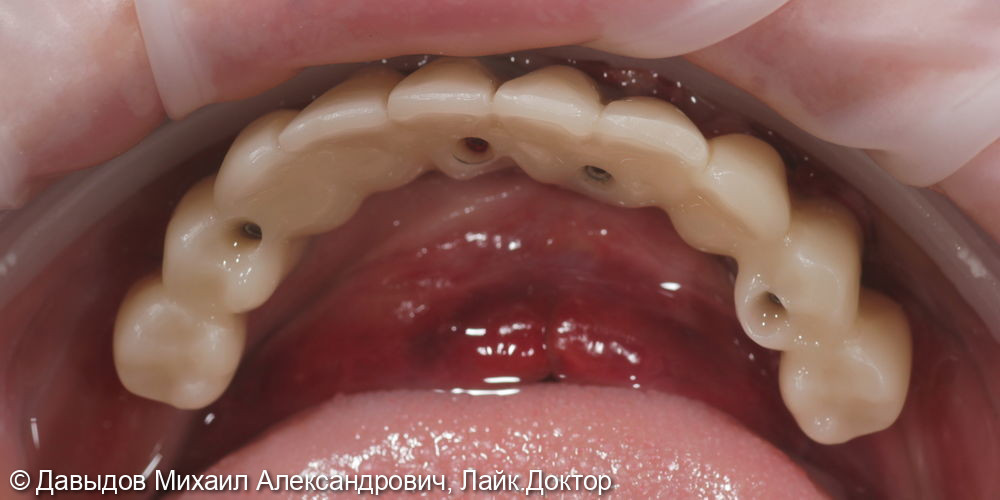 Зубы за один день: установка 4-х имплантов с немедленной нагрузкой - фото №9