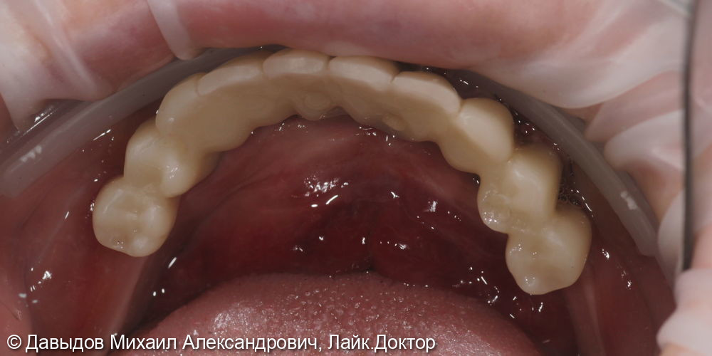 Зубы за один день: установка 4-х имплантов с немедленной нагрузкой - фото №10