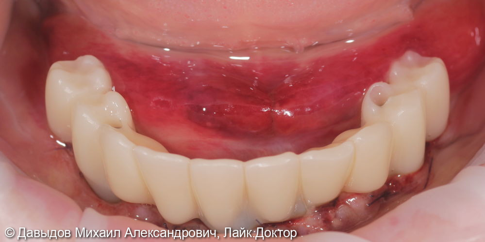 Зубы за один день: установка 4-х имплантов с немедленной нагрузкой - фото №11