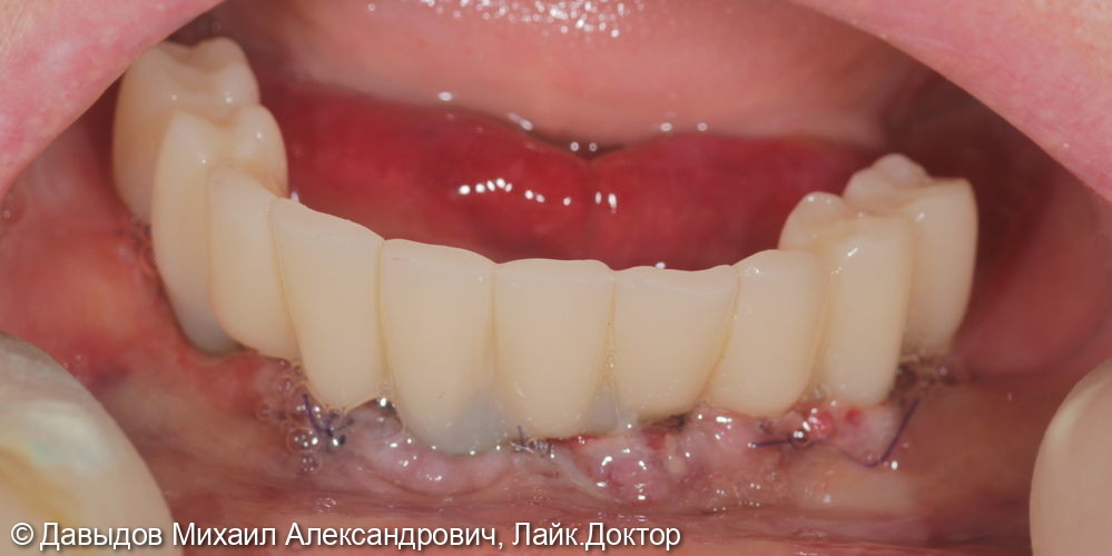 Зубы за один день: установка 4-х имплантов с немедленной нагрузкой - фото №12