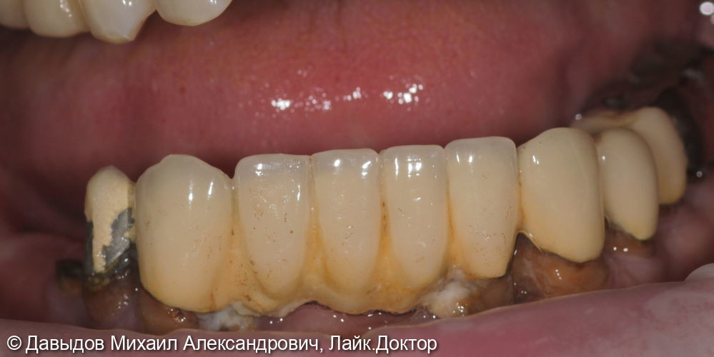 Зубы за один день на 6ти имплантах - фото №1