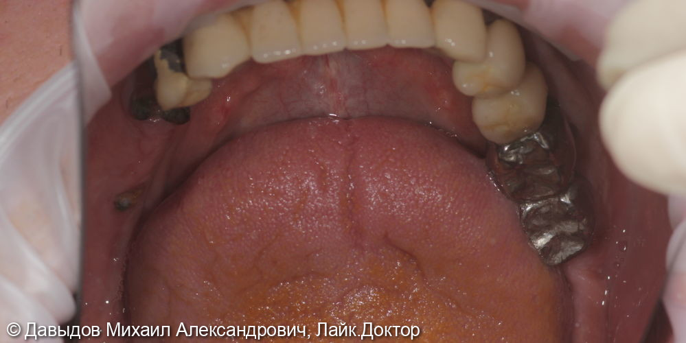 Зубы за один день на 6ти имплантах - фото №2