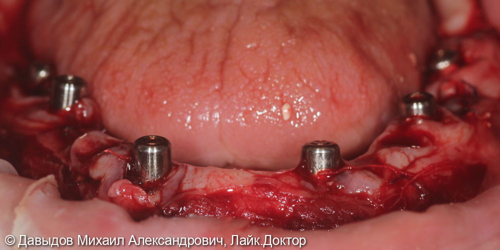 Зубы за один день на 6ти имплантах - фото №3
