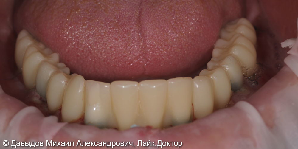 Зубы за один день на 6ти имплантах - фото №5
