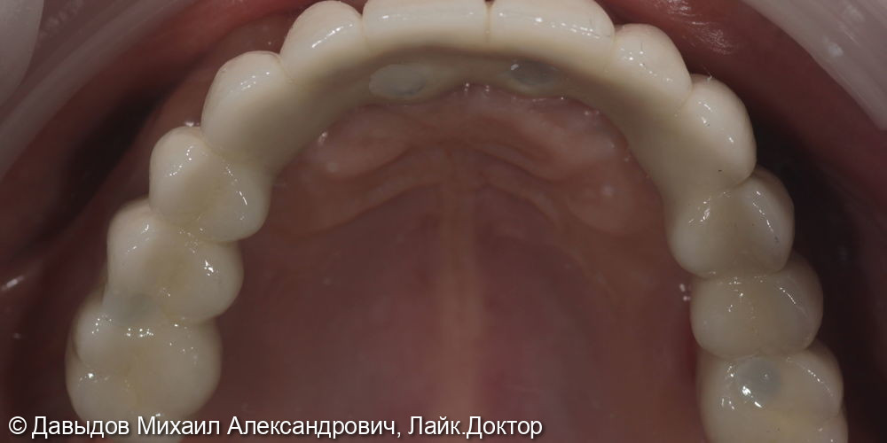 Тотальная реконструкция зубов - фото №13