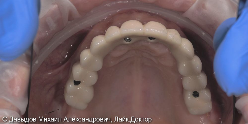 Тотальная реконструкция зубов - фото №15