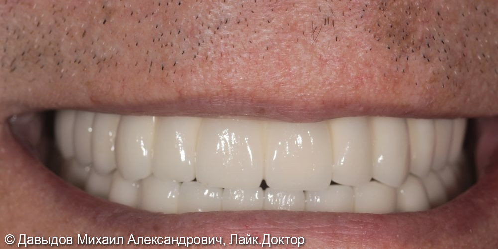 Тотальная реконструкция зубов - фото №16