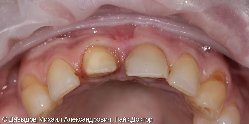 Немедленное восстановление целостности зубного ряда - фото №2