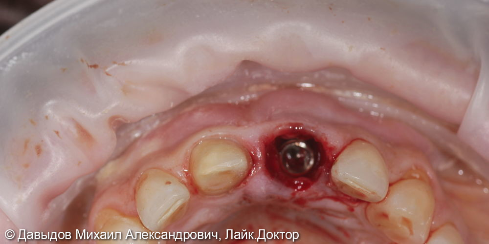 Немедленное восстановление целостности зубного ряда - фото №5
