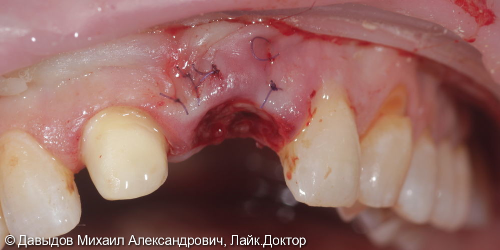 Немедленное восстановление целостности зубного ряда - фото №7