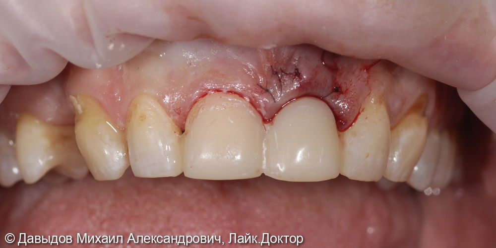 Немедленное восстановление целостности зубного ряда - фото №8