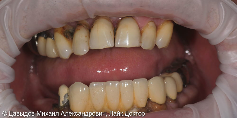 Функционально-эстетическая реконструкция зубо-челюстной системы - фото №1