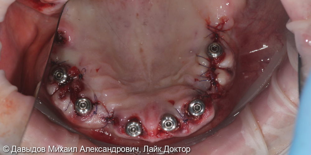 Функционально-эстетическая реконструкция зубо-челюстной системы - фото №9