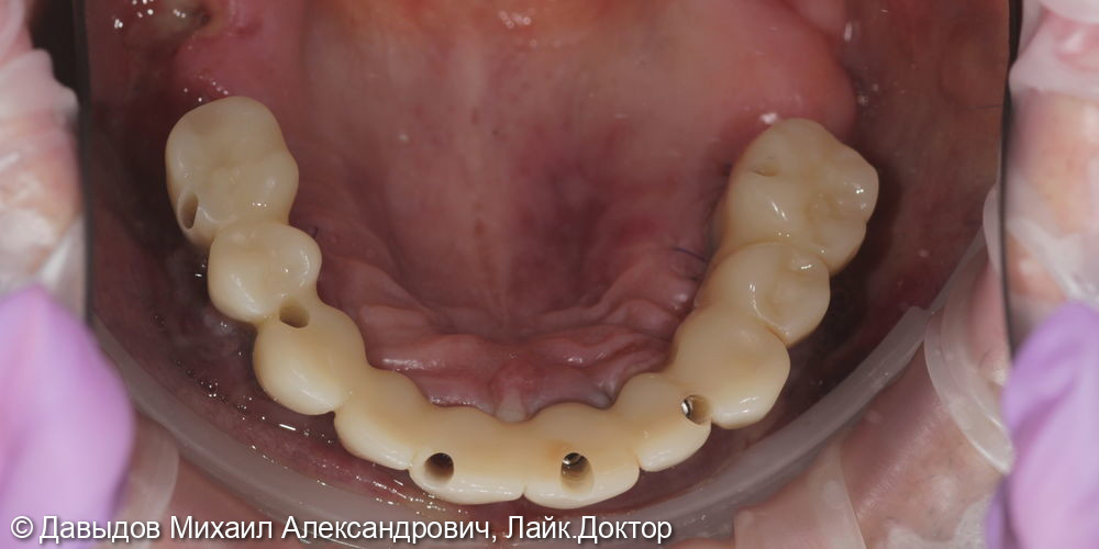 Функционально-эстетическая реконструкция зубо-челюстной системы - фото №12
