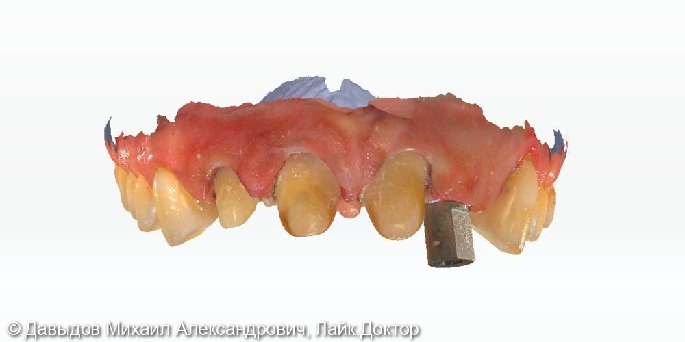 Протезирование фронтальной группы зубов в цифровом протоколе - фото №1