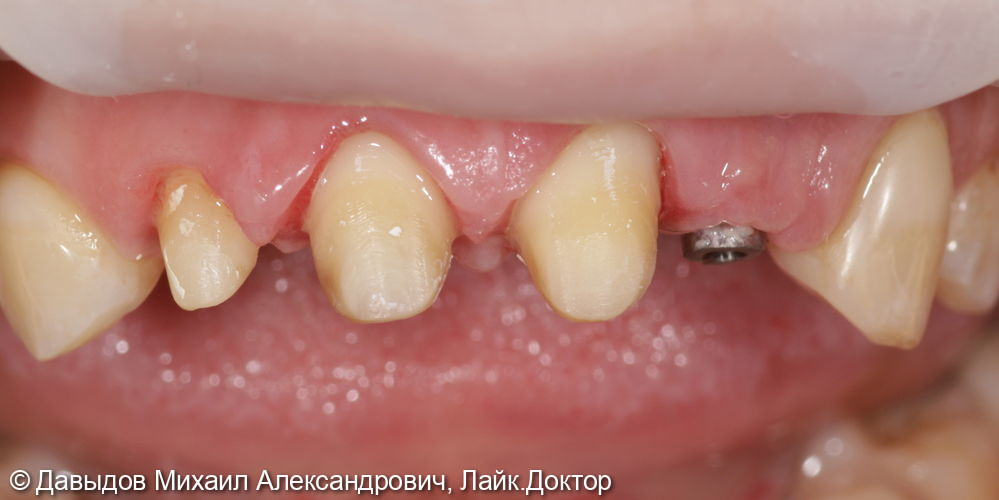 Протезирование фронтальной группы зубов в цифровом протоколе - фото №2