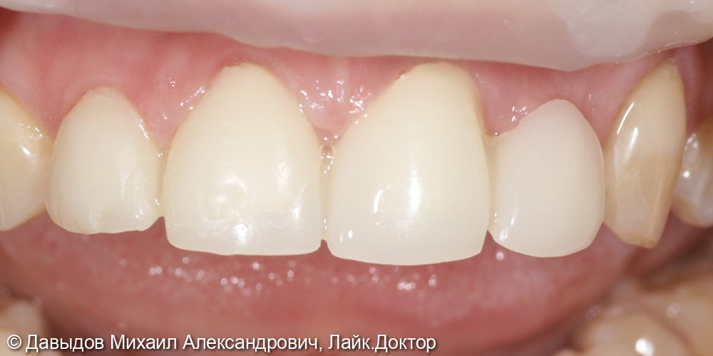 Протезирование фронтальной группы зубов в цифровом протоколе - фото №3