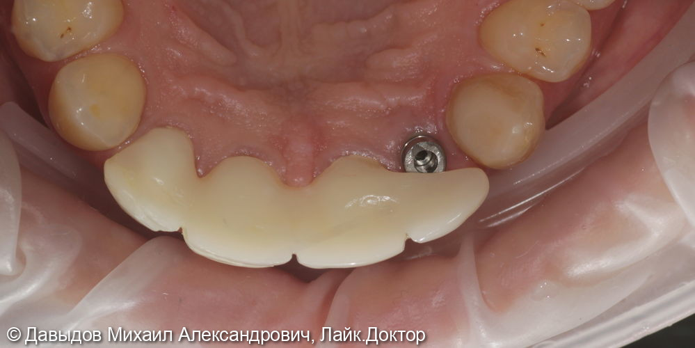 Протезирование фронтальной группы зубов в цифровом протоколе - фото №4