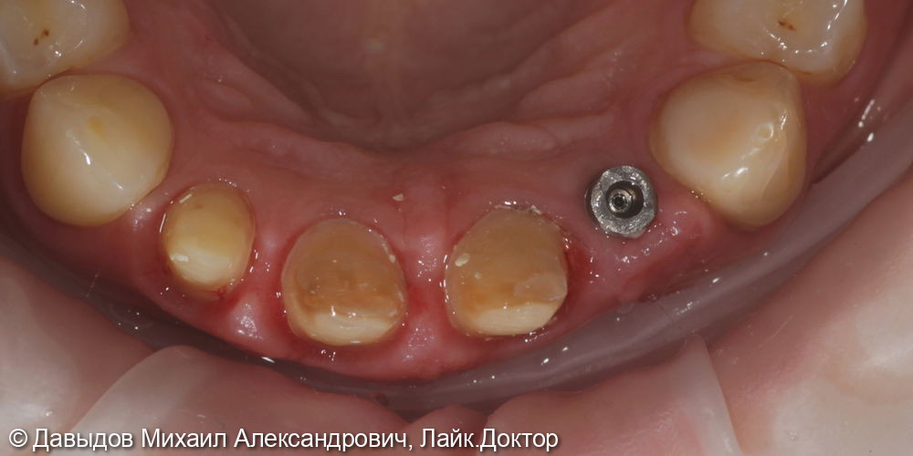 Протезирование фронтальной группы зубов в цифровом протоколе - фото №5