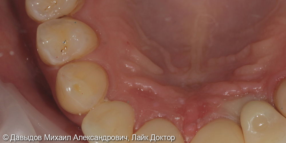 Протезирование фронтальной группы зубов в цифровом протоколе - фото №6