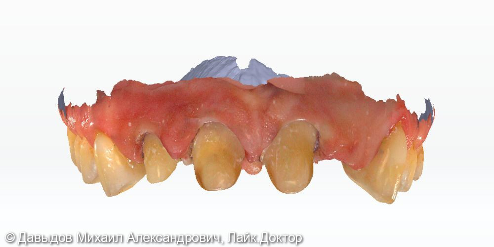 Протезирование фронтальной группы зубов в цифровом протоколе - фото №7