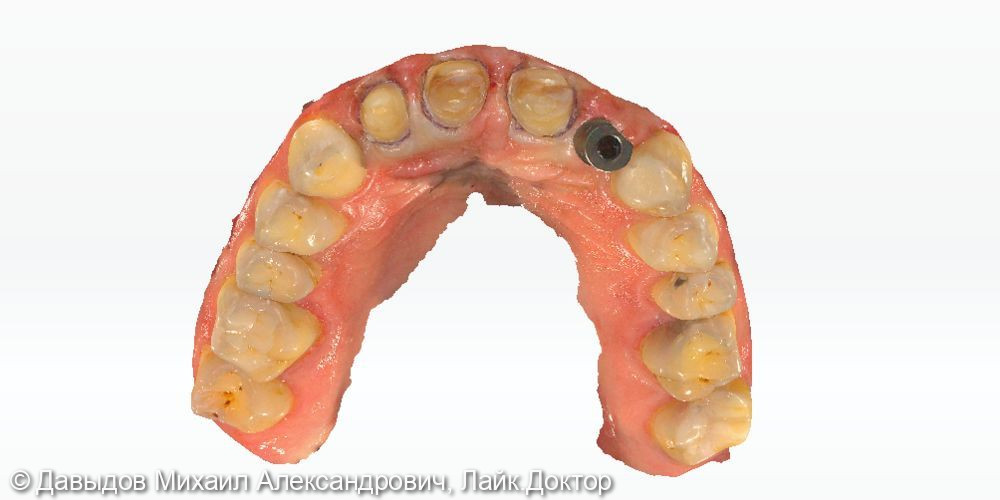 Протезирование фронтальной группы зубов в цифровом протоколе - фото №9