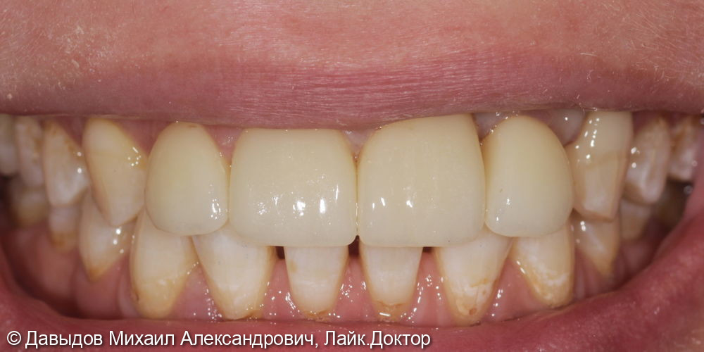 Протезирование фронтальной группы зубов в цифровом протоколе - фото №10