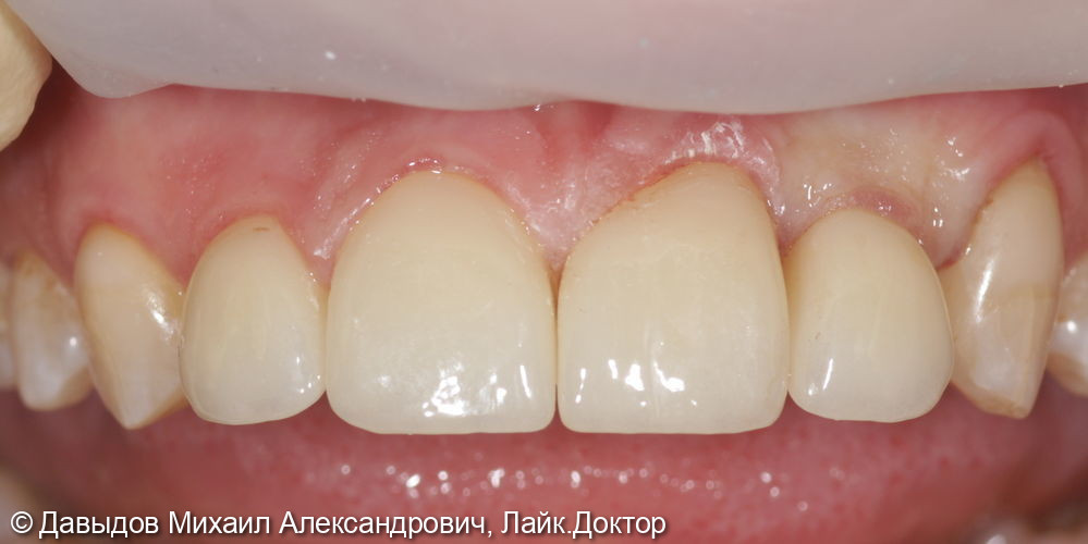 Протезирование фронтальной группы зубов в цифровом протоколе - фото №11