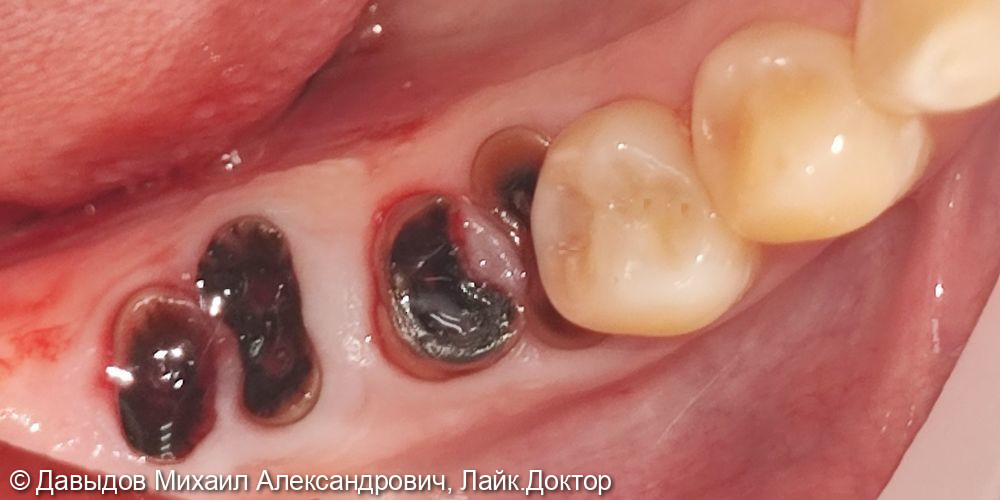 Одномоментная имплантация жевательных зубов с последующей установкой коронок из диоксида циркония в цифровом протоколе - фото №1