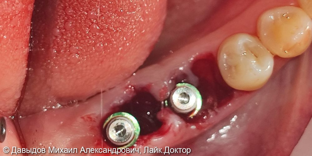 Одномоментная имплантация жевательных зубов с последующей установкой коронок из диоксида циркония в цифровом протоколе - фото №2