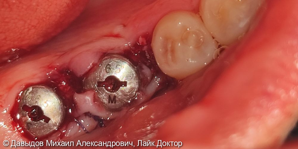 Одномоментная имплантация жевательных зубов с последующей установкой коронок из диоксида циркония в цифровом протоколе - фото №3