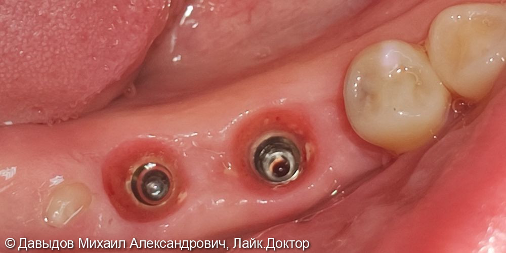 Одномоментная имплантация жевательных зубов с последующей установкой коронок из диоксида циркония в цифровом протоколе - фото №4
