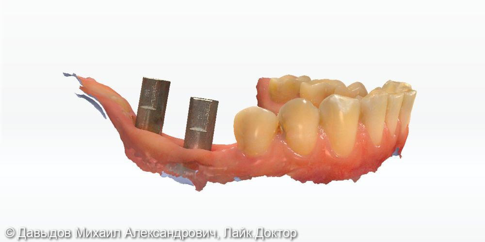 Одномоментная имплантация жевательных зубов с последующей установкой коронок из диоксида циркония в цифровом протоколе - фото №5