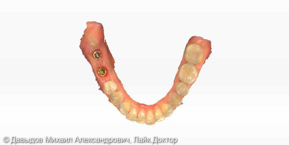 Одномоментная имплантация жевательных зубов с последующей установкой коронок из диоксида циркония в цифровом протоколе - фото №6