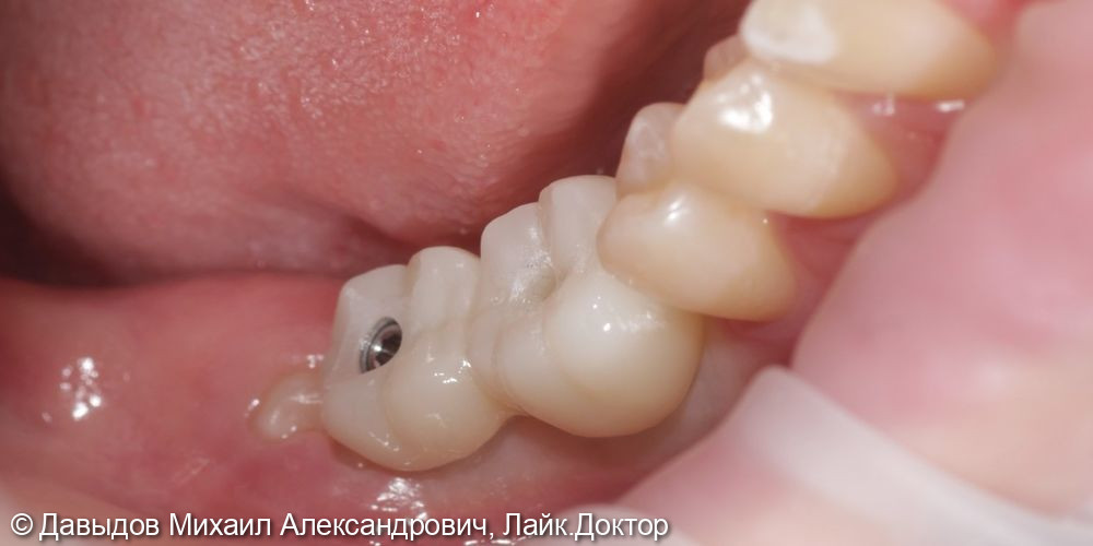 Одномоментная имплантация жевательных зубов с последующей установкой коронок из диоксида циркония в цифровом протоколе - фото №7