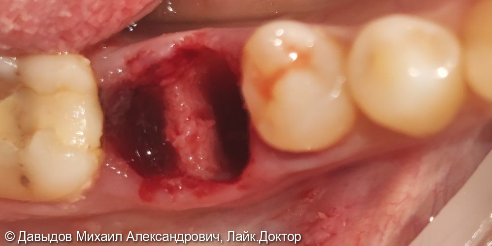 Удаление зуба 36 с одномоментной установкой импланта - фото №2